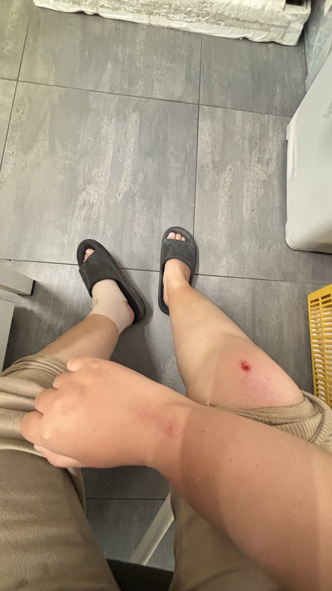 _meyong's tweet photo. luka seitil sakitnya bukan main https://t.co/pA6itFvSbF