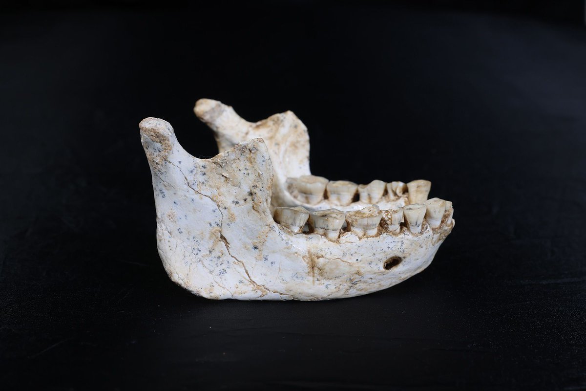 SamaHoole's tweet photo. Tooth decay is a plant disease, and the worst teeth in the Stone Age belonged to the people eating the most plants.

There is a cave in eastern Morocco called the Grotte des Pigeons. Around 15,000 years ago, well before farming and many thousands of years before anyone refined a grain of sugar, a community of hunter-gatherers buried their dead in it.

When the skeletons were examined, 51% of the adult teeth had cavities. Of 52 adults, only 3 had a clean mouth. Abscesses, teeth rotted to stumps, the lot. That is a decay rate you would expect from a modern population raised on fizzy drinks, and these people had never seen a field.

What they had seen was acorns. The cave floor was thick with the remains of them, along with pine nuts, gathered in bulk and stored. A sticky, starchy plant harvest, eaten daily. The bacteria in a human mouth ferment starch and sugar into acid, and the acid eats the enamel. That is all a cavity has ever been.

Compare the neighbours. Hunter-gatherers living mostly off animals routinely show decay in a low single-digit share of their teeth, and often in none at all. No toothbrush, no fluoride, no hygienist, no floss. Mouth bacteria cannot ferment meat or fat, so there was nothing to make the acid from.

So the experiment has been run, and it was run without sweets, without soft drinks and without a single food manufacturer to blame. Change one thing, the amount of plant starch going through the mouth, and a Stone Age jaw turns into a dentist's pension.

Your dentist knows the mechanism perfectly well. It is on the wall of the waiting room, next to the advice to eat plenty of wholegrains.

Brushing twice a day is how you apologise to your teeth for breakfast.