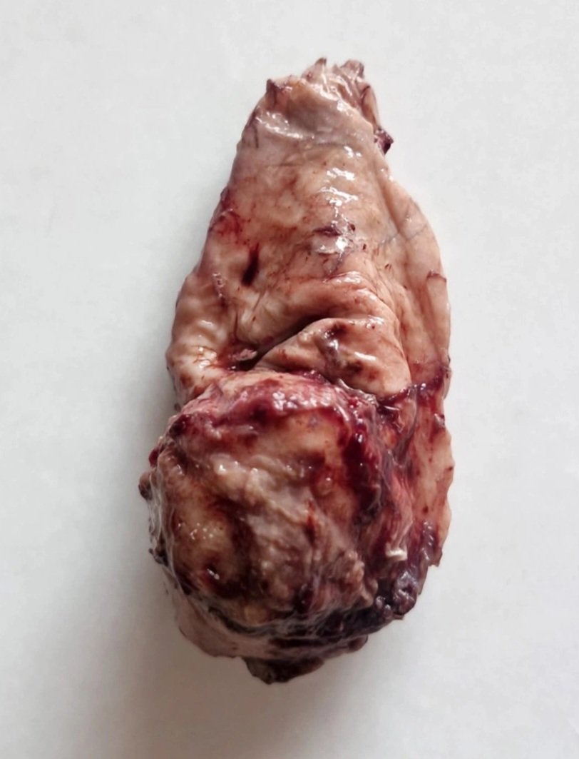 arthy_os's tweet photo. 75/m, b/l hydrocele,thickened  sac, Michaelis gutman bodies in Malakoplakia, epididymis, a rare site https://t.co/saQZsAVobJ