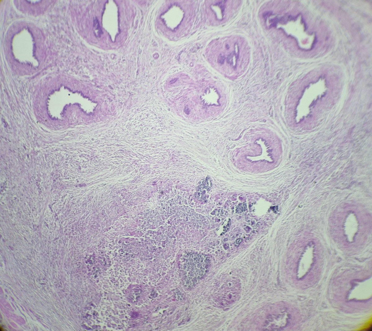arthy_os's tweet photo. 75/m, b/l hydrocele,thickened  sac, Michaelis gutman bodies in Malakoplakia, epididymis, a rare site https://t.co/saQZsAVobJ