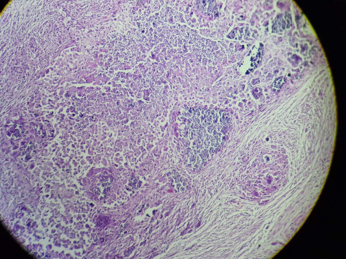 arthy_os's tweet photo. 75/m, b/l hydrocele,thickened  sac, Michaelis gutman bodies in Malakoplakia, epididymis, a rare site https://t.co/saQZsAVobJ