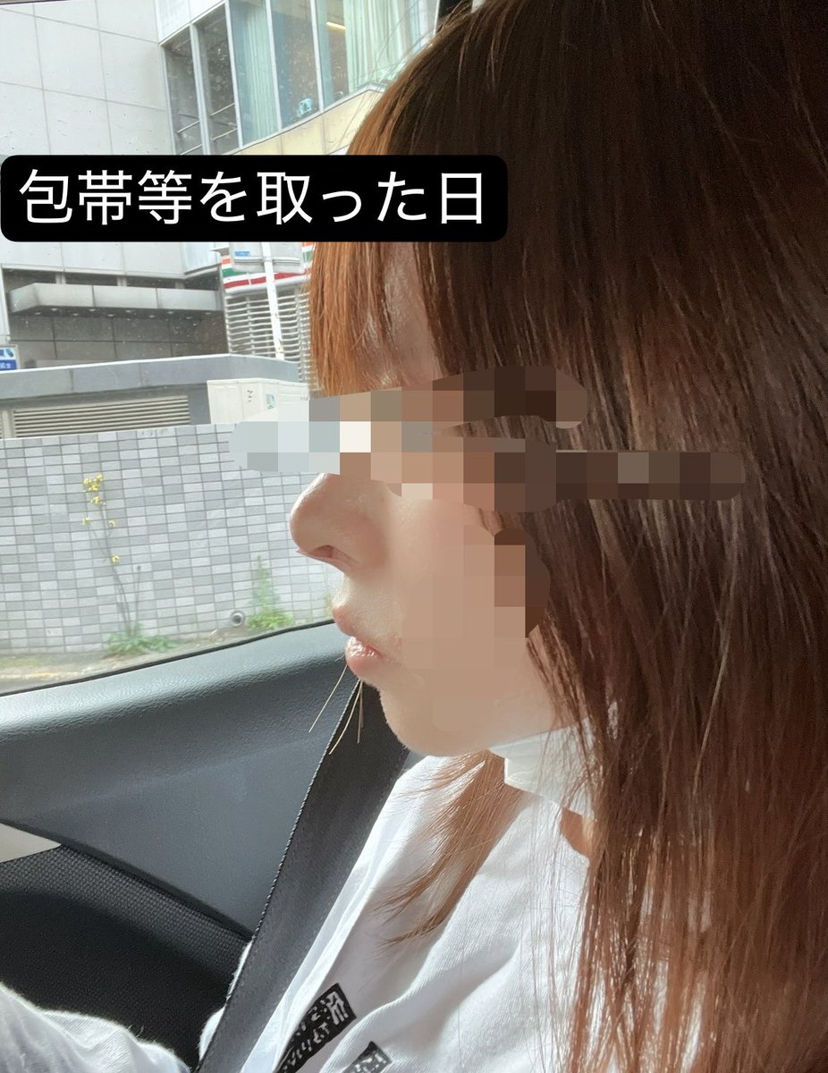 tilcay0's tweet photo. 鼻整形なんかざわざわしてる気がするからわたしもビンジョルノしたい
めっちゃ成功していると思ってる
なんなら見た目人中も短くなったし最高 https://t.co/hVMbZXf6aP