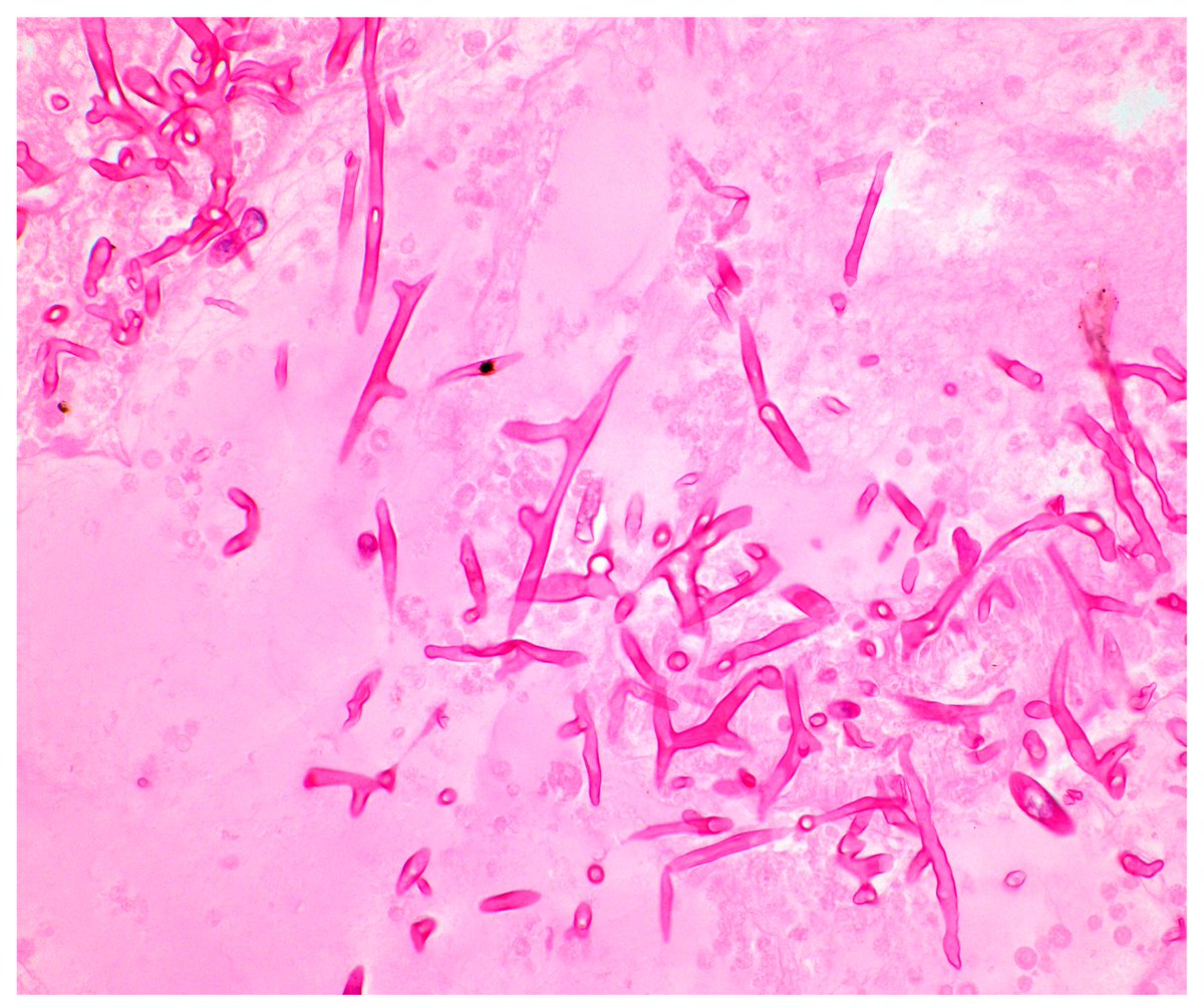 JoF_MDPI's tweet photo. Recent Advances in Diagnostic Approaches for Mucormycosis

A recent review published in the Journal of Fungi provides an overview of current and emerging approaches for diagnosing mucormycosis.

📖 Read the full article: https://t.co/4aDx8q94P0

#Mucormycosis #Mucorales https://t.co/QMKBhWemZE