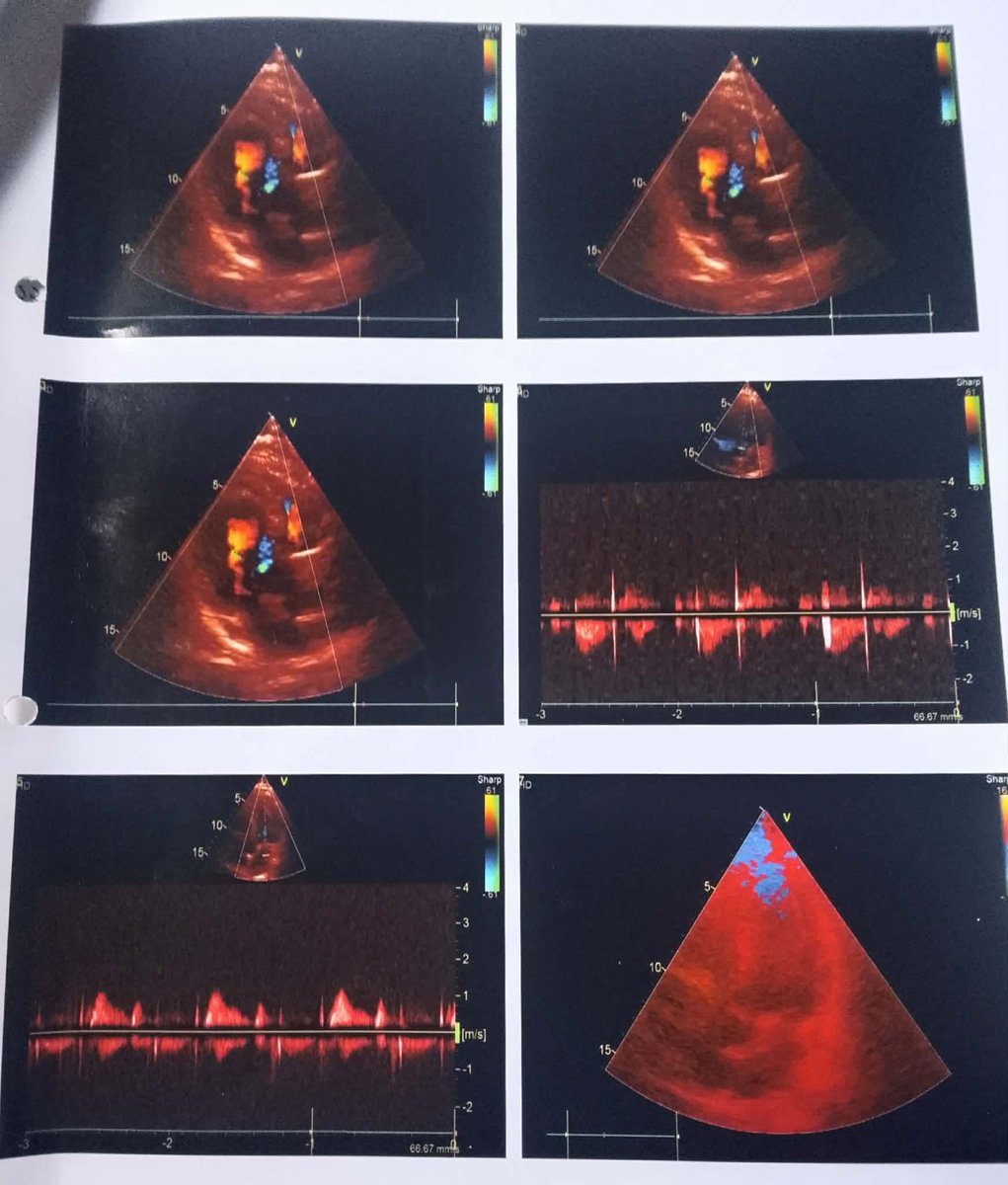 ShimulFeni7's tweet photo. It will cost 300,000 BDT to have two stents inserted; I cannot afford this on my own, so I am seeking everyone's assistance. I have provided my bank account 
Shimul Chandra Das
Dutch-Bangla Bank
Account No.: 14010117528
Feni Main Branch
Bangladesh
Mobile: 008801731998877 https://t.co/8xR43Cc1f6