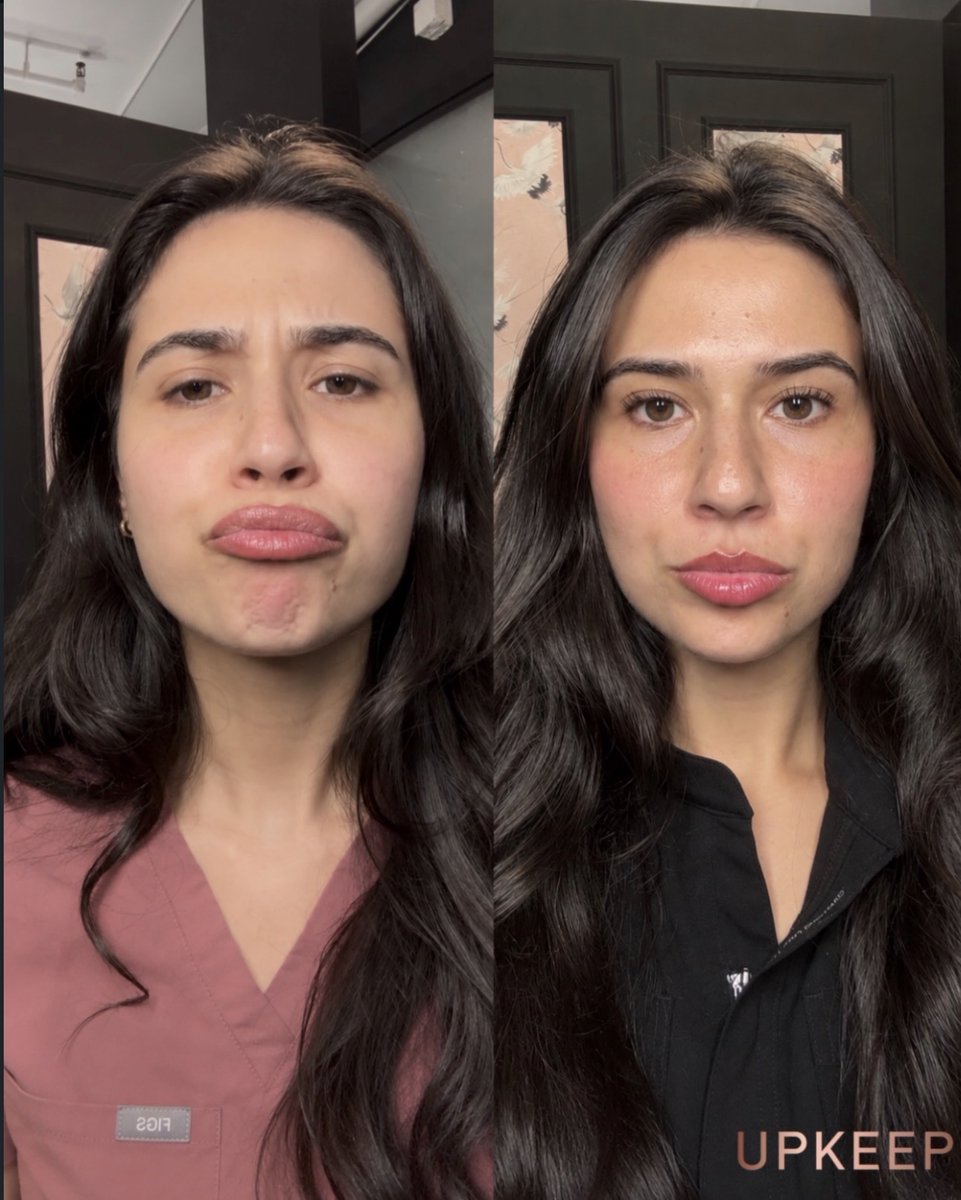 UPKEEPMEDSPA's tweet photo. A little Dysport, a personalized refresh. ✨ 

Curious about softening expression lines? Let’s talk about your goals and whether Dysport is right for you.

Book your UPKEEP consultation: https://t.co/E215qBrYlc 

#Dysport #UPKEEPMedSpa https://t.co/V8wzIQMDx4