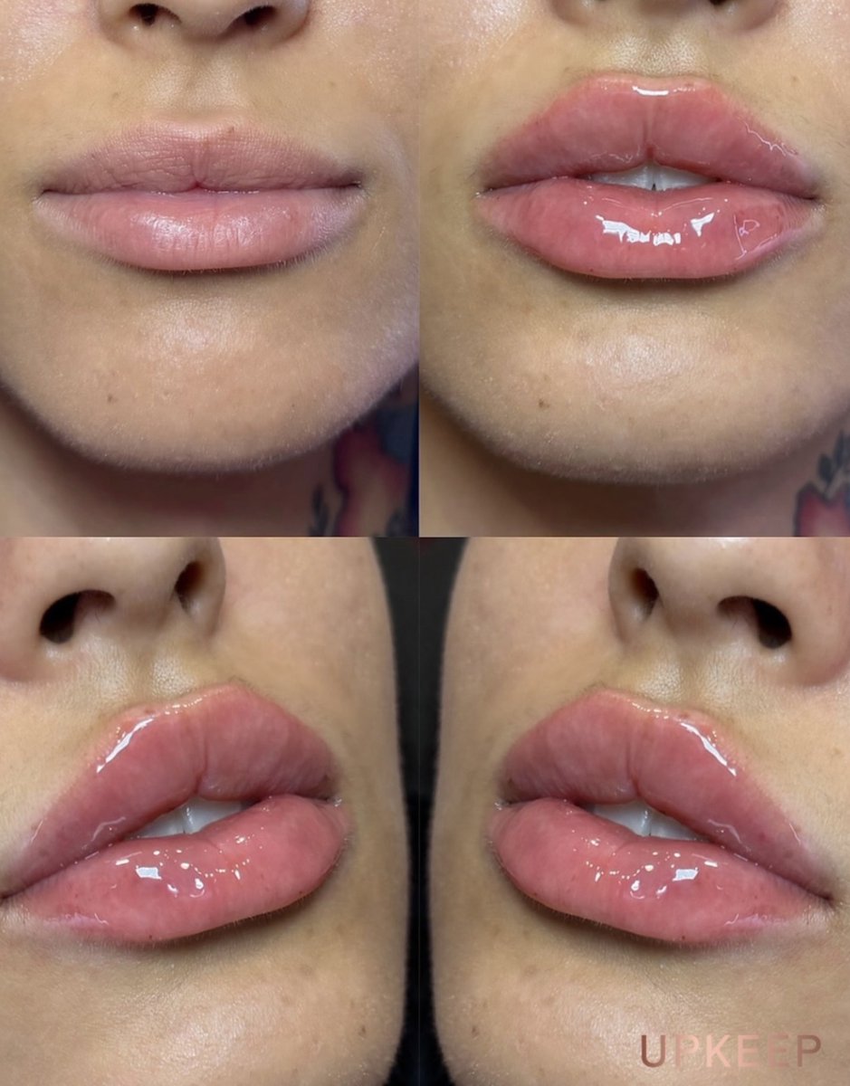 UPKEEPMEDSPA's tweet photo. A little Kysse, a fuller pout. 💋✨ This lip transformation features 1 mL of Restylane® Kysse filler at UPKEEP.

Ready for your lip refresh? Book a personalized consultation: https://t.co/E215qBswaK

#UPKEEPMedSpa #RestylaneKysse #LipFiller https://t.co/0mndujTRYM