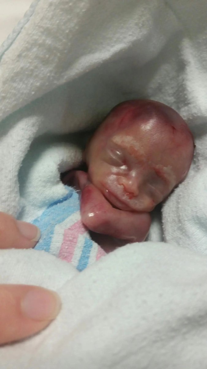 LilaGraceRose's tweet photo. Greyson was miscarried at 19 weeks.

He lived for 2 hours after his birth.

He had fingernails and toenails.

He was a person, just like every other baby at this age.

He deserved his chance at life. https://t.co/eVxY8qn7BF