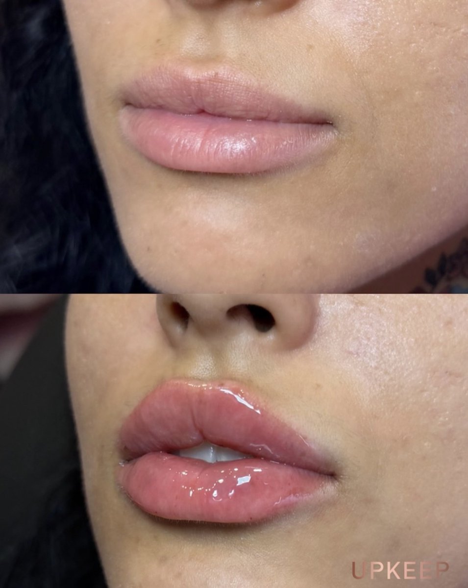 UPKEEPMEDSPA's tweet photo. A little Kysse, a fuller pout. 💋✨ This lip transformation features 1 mL of Restylane® Kysse filler at UPKEEP.

Ready for your lip refresh? Book a personalized consultation: https://t.co/E215qBswaK

#UPKEEPMedSpa #RestylaneKysse #LipFiller https://t.co/0mndujTRYM