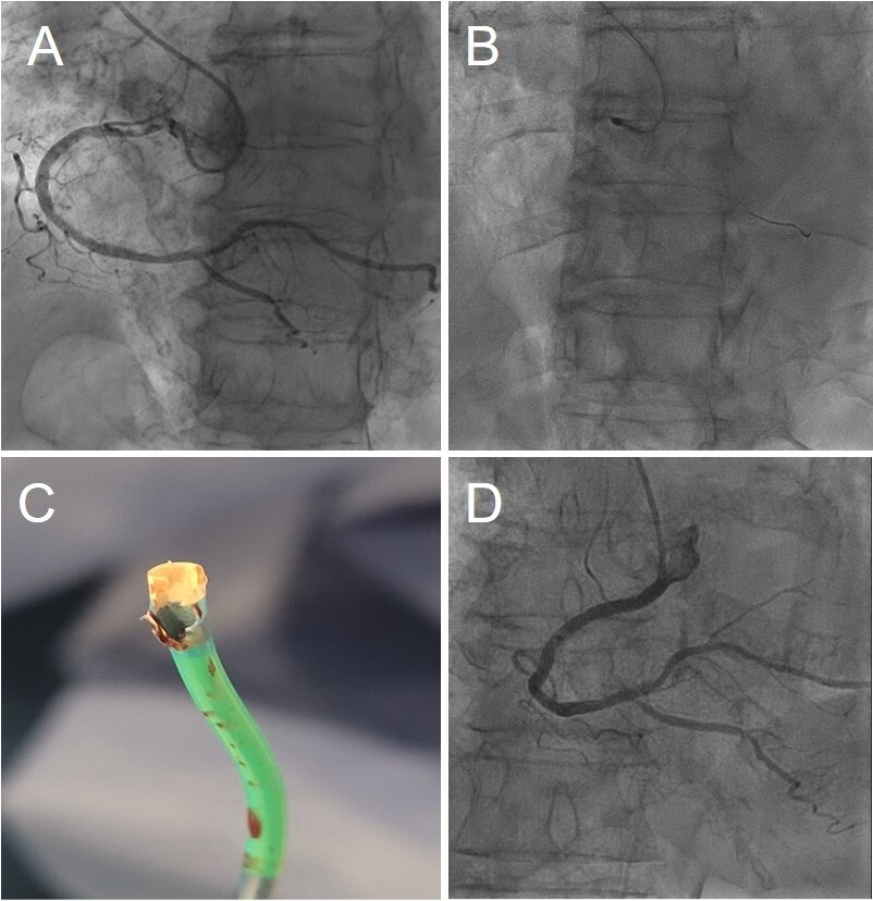 InvasiveCardiol's tweet photo. 🏆 Congratulations to the authors of the most-read article in September!

Ablation of the Ablator: Accidental Guide Catheter Machining by a 1.75-mm Burr in a 6F Amplatz Guide

https://t.co/53eikuBRru

@DLBHATTMD #cardioTwitter #cardioX #cardiology #interventionalcardiology https://t.co/lemEulP9SV