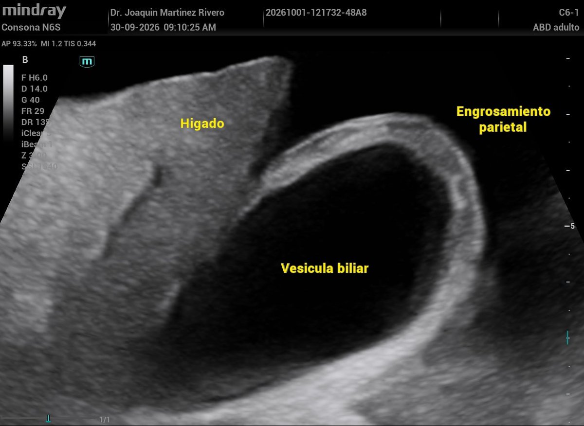 JMMR83's tweet photo. Engrosamiento de pared vesicular en cirrosis. https://t.co/m7okqDBUkg