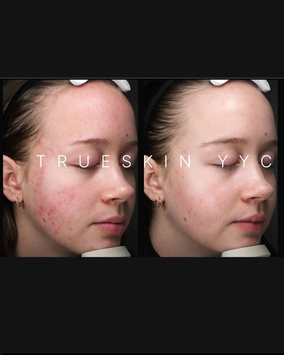 TrueSkinYYC's tweet photo. Real skin. Real progress. Healthy skin, real results.✨

💗 Ready to start your skin journey? Book your personalized skin consultation at TrueSkin Clinic and receive 20% OFF your first visit!

📞 Call/Text: 403-890-9602
📧 info@trueskinclinic.ca
🌐 https://t.co/cJnDNBsuZa https://t.co/qKX1METIqW