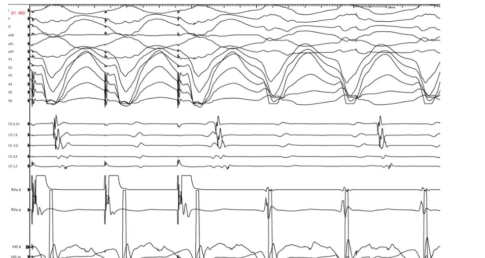PennEPFellows's tweet photo. Unknown of the day. Case with the incredible @drhbkmd 

What is rhythm? https://t.co/bOdu4MJUCP