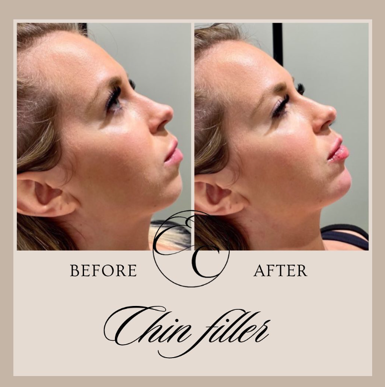 EnhanceClinicBe's tweet photo. 𝐂𝐡𝐢𝐧 𝐟𝐢𝐥𝐥𝐞𝐫 💉

1ML filler in the chin for this beauty!
Visit: https://t.co/6dB9J2u01O
🕣 Appointment time: 20 min
🤕 Downtime: Bit of swelling and bruising can accur, allow two weeks to fully settle.

#enhanceclinic #aesthetic #ghent #botox #beauty #fillers #skincare https://t.co/nRttfQUdHx