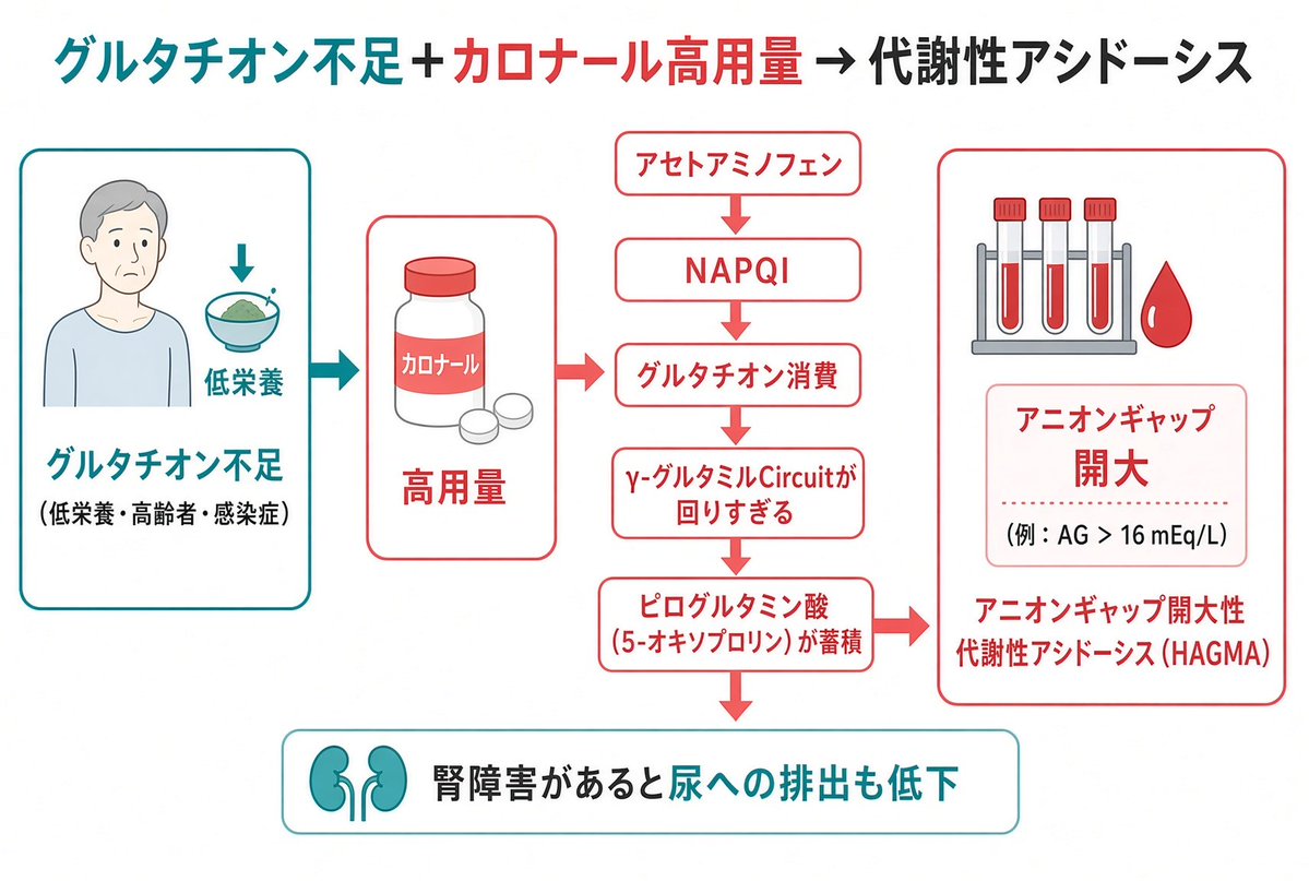 fseiichizb4's tweet photo. 2026.8 アセトアミノフェン（カロナール）に注意喚起
カロナールは体内のグルタチオンを消費してしまう。
回路の中間体（ピログルタミン酸）が蓄積して代謝性アシドーシスになることがある。

カロナールで食欲不振、悪心、倦怠感でたら注意
https://t.co/X9anGSqJsk https://t.co/K9eco4CD9c