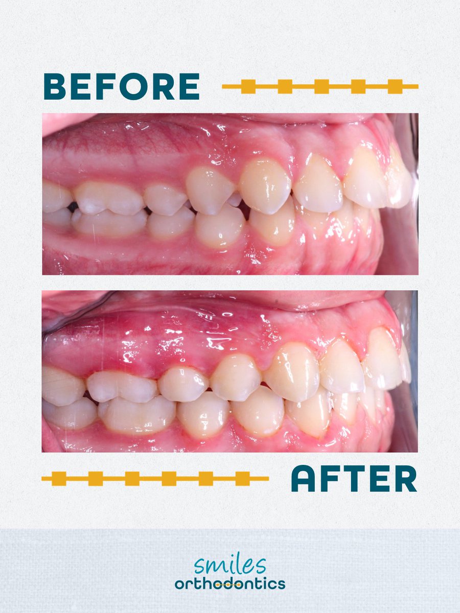 smilesortho's tweet photo. Braces off for Blas! 💙 

A beautiful smile is great, but one that looks good and functions well is even better! 👏

#BracesOff #Orthodontics #Wichita https://t.co/o76QDgABn2
