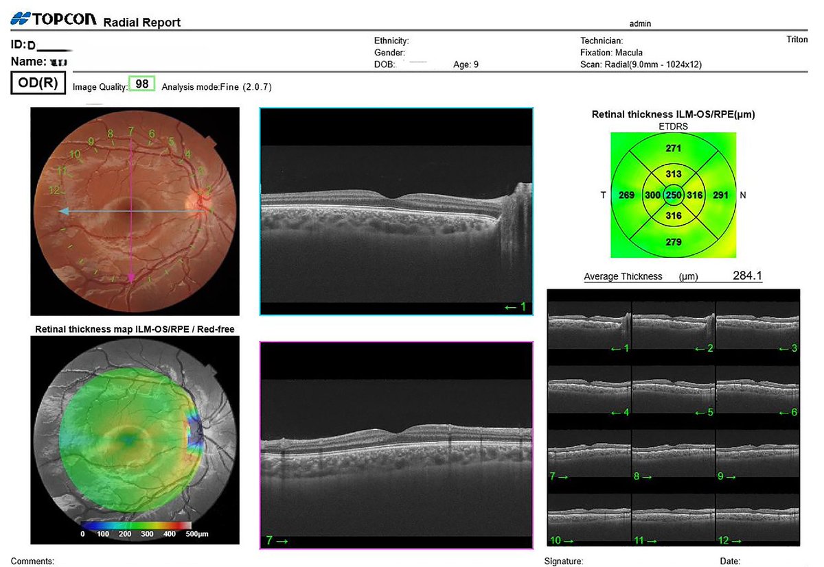 revoptom's tweet photo. SER Influences Ocular Structural Measurements in Children

Those with higher myopia presented significant variations in macular RNFL and GCL, as well as generalized choroidal thinning.

https://t.co/PLMPRxZgq0

#optometry #optometrist #eyecare #myopia #pediatriccare #retina https://t.co/AWWQWZc5X3
