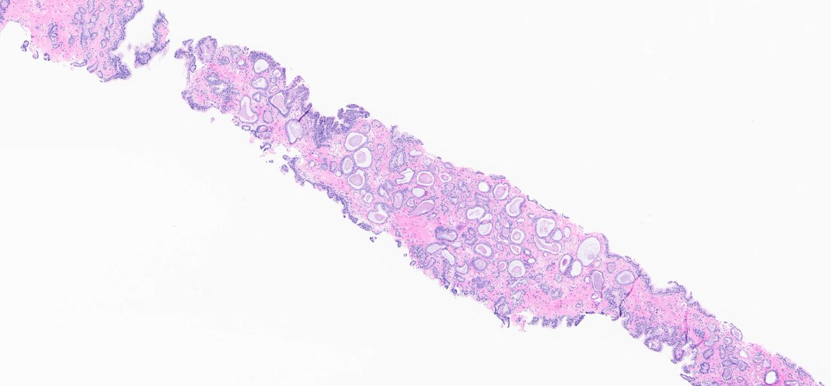rovingatuscap's tweet photo. Prostate cancer with atrophic features - note attenuated, yet rigid luminal borders + dense pink intraluminal secretions; at higher magnification (lower R) = prominent nucleoli
As in most cases, elements of usual acinar adenoCA (see 2 ends of L side image) are present https://t.co/vmr4crlLEv