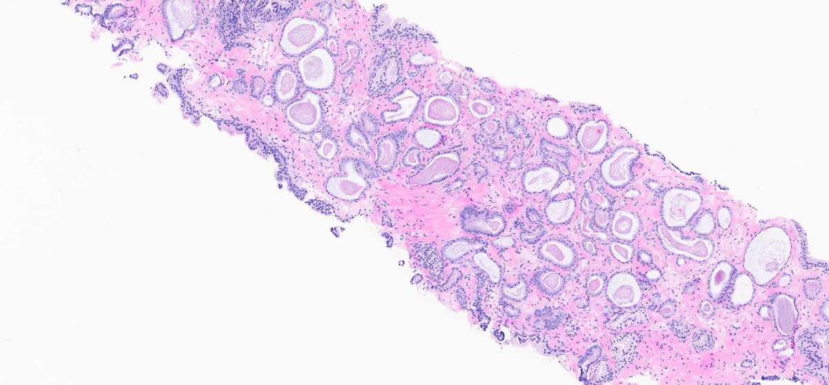 rovingatuscap's tweet photo. Prostate cancer with atrophic features - note attenuated, yet rigid luminal borders + dense pink intraluminal secretions; at higher magnification (lower R) = prominent nucleoli
As in most cases, elements of usual acinar adenoCA (see 2 ends of L side image) are present https://t.co/vmr4crlLEv