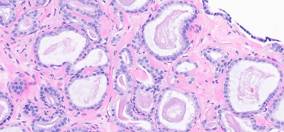 rovingatuscap's tweet photo. Prostate cancer with atrophic features - note attenuated, yet rigid luminal borders + dense pink intraluminal secretions; at higher magnification (lower R) = prominent nucleoli
As in most cases, elements of usual acinar adenoCA (see 2 ends of L side image) are present https://t.co/vmr4crlLEv