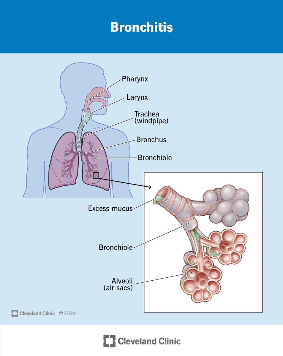 ClevelandClinic's tweet photo. Bronchitis is when the airways leading to your lungs (trachea and bronchi) get inflamed and fill with mucus. You get a nagging cough as your body tries to get rid of the mucus. Your cough can last two or more weeks. Acute bronchitis is usually caused by a virus and goes away on its own. Chronic bronchitis never really goes away but can be managed.

Acute bronchitis is usually not treated with medications. If you have the flu and your symptoms started within the past two days, your provider may prescribe antivirals to help it go away faster.

Since bronchitis is almost never caused by bacteria, antibiotics won’t help you get better and might even make you feel worse. You can manage the symptoms of bronchitis at home with over-the-counter medicines and rest. Running a humidifier or taking warm showers can help loosen mucus and make breathing easier.

It’s tough to know whether you have bronchitis or something more serious. See your healthcare provider if you have:

A cough that lasts more than three weeks.
A fever greater than 102° F.
A fever that lasts more than five days.
A cough that produces blood.
Shortness of breath or wheezing.