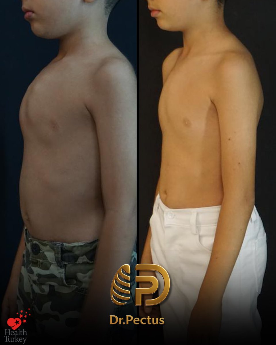 drpektus's tweet photo. ✨ Transformation over 3 years of non-surgical treatment

📸 The images show the changes observed throughout our patient’s treatment journey. Every patient’s deformity, growth pattern, and response to treatment may differ.

#pectus #pectusexcavatum #pectuscarinatum #vacuumbell https://t.co/HfraUZYNWW