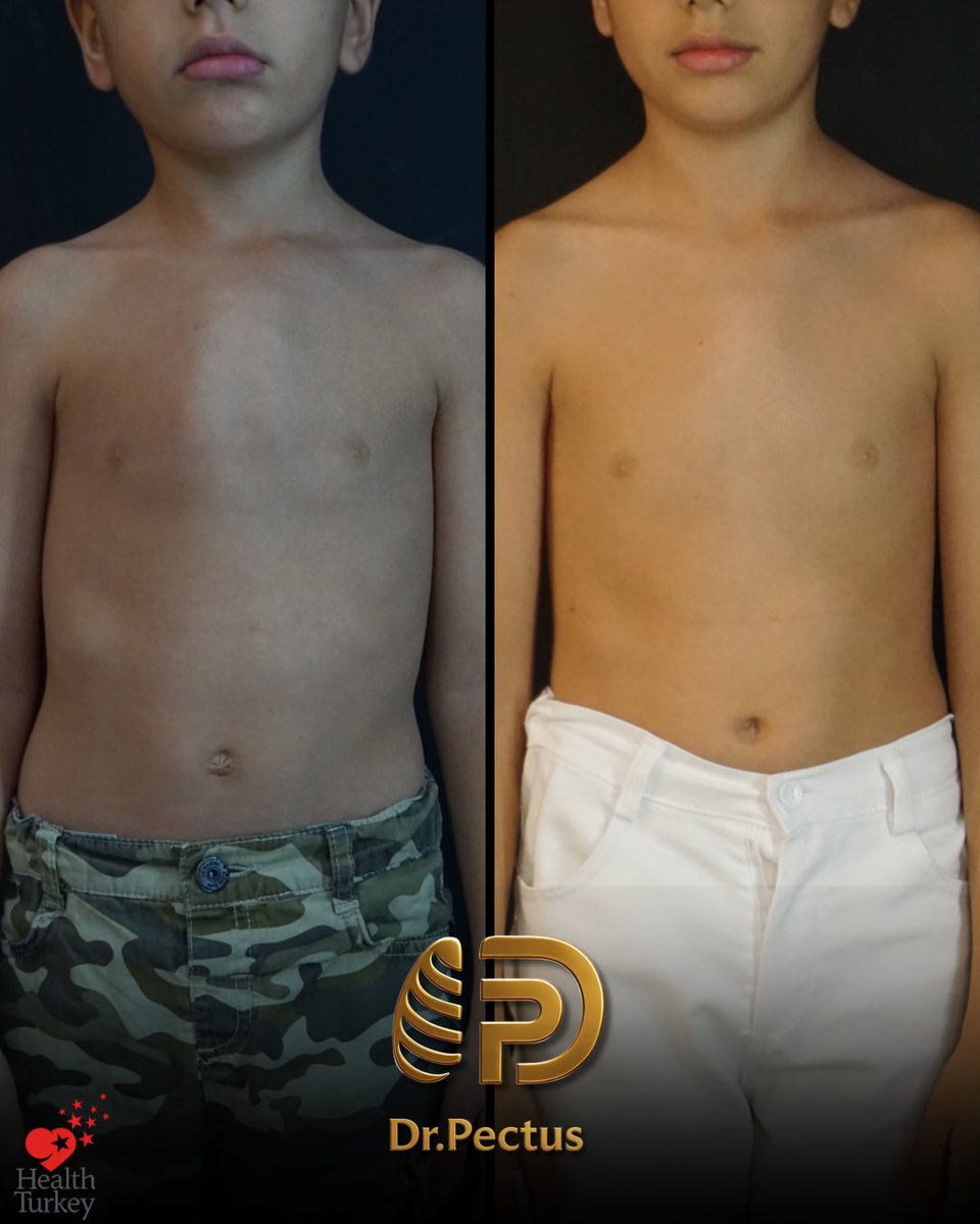 drpektus's tweet photo. ✨ Transformation over 3 years of non-surgical treatment

📸 The images show the changes observed throughout our patient’s treatment journey. Every patient’s deformity, growth pattern, and response to treatment may differ.

#pectus #pectusexcavatum #pectuscarinatum #vacuumbell https://t.co/HfraUZYNWW