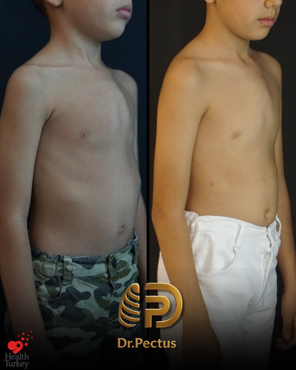 drpektus's tweet photo. ✨ Transformation over 3 years of non-surgical treatment

📸 The images show the changes observed throughout our patient’s treatment journey. Every patient’s deformity, growth pattern, and response to treatment may differ.

#pectus #pectusexcavatum #pectuscarinatum #vacuumbell https://t.co/HfraUZYNWW