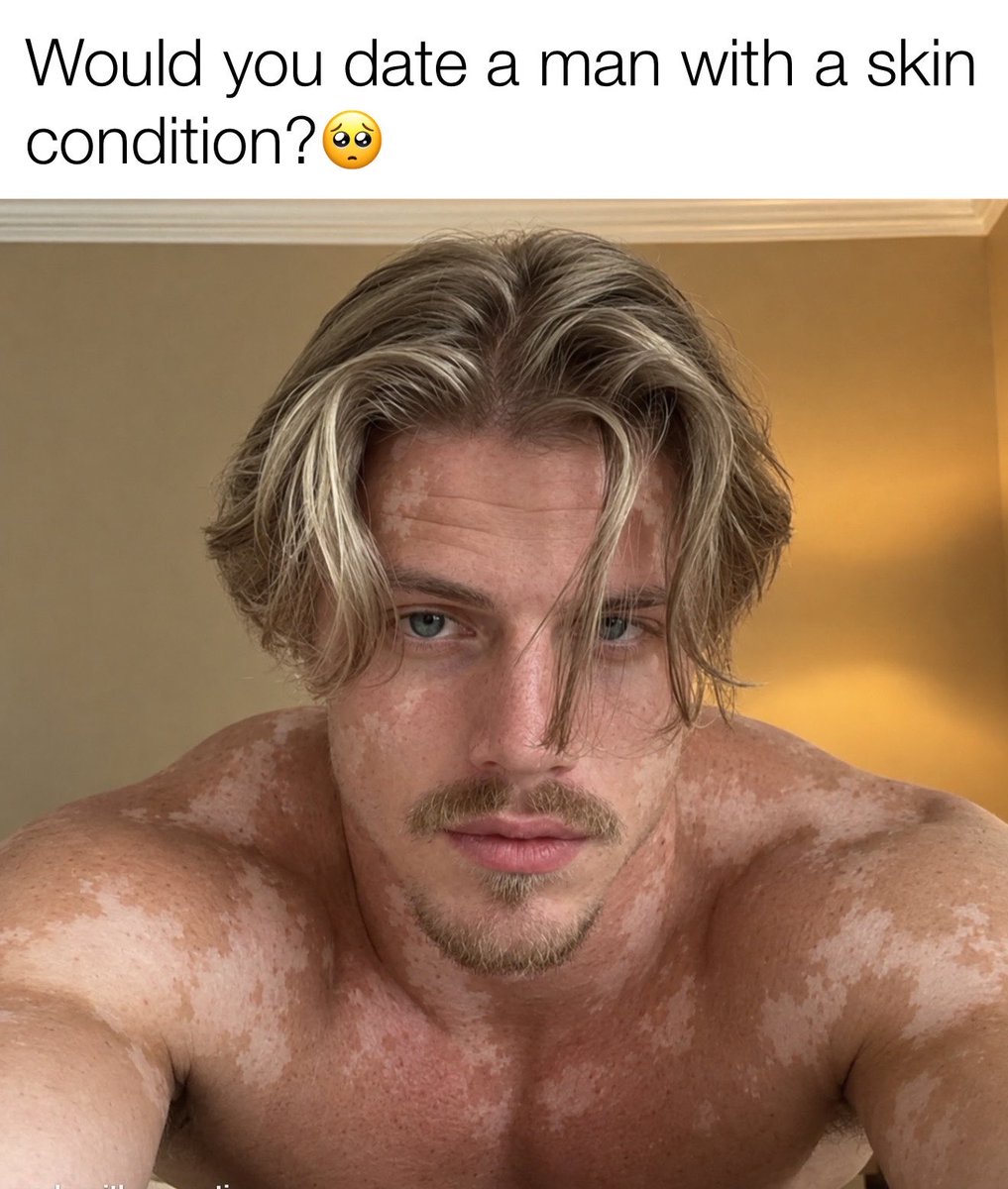 _everythingmen's tweet photo. I've dated someone with vitiligo before, and I would sometimes notice him getting insecure about it, but it never really bothered me. https://t.co/mxssDFRrxV