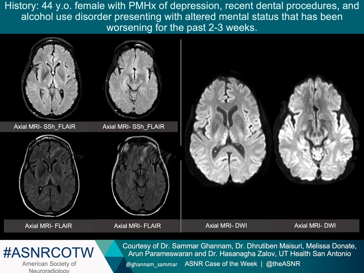 TheASNR's tweet photo. ASNR COTW # 315

Hx: 44 y/o female with depression, dental procedures and alcohol use disorder with altered mental status 

NO SPOILERS! Give hints in the form of GIFs or answer poll. Answer in 24 hours.  

#neuro #neurorad #radres #FOAMed #FOAMrad #medtwitter #ASNRCOTW https://t.co/OXRceqiVhh