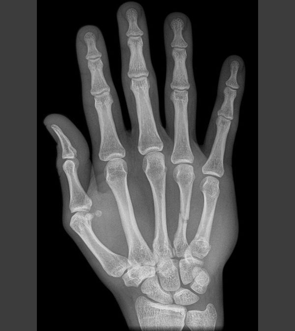 RadMasterclass's tweet photo. TRAUMA X-RAY 62: What is the most common mechanism of this injury? Answer https://t.co/RSoJakibYr https://t.co/xDvGt9gLkg