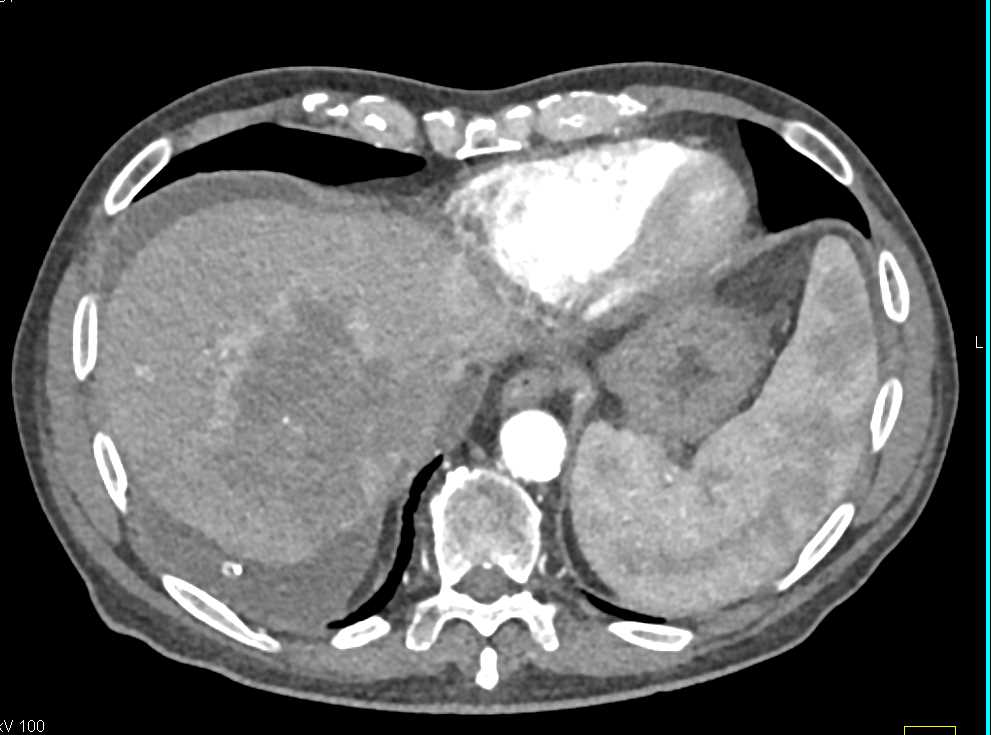 ctisus's tweet photo. October is Liver Cancer Awareness Month so today we'll be sharing cases of liver cancer

Multifocal Hepatocellular Carcinoma (Hepatoma): https://t.co/2ee2uxL0Yh https://t.co/kccpjXKleV
