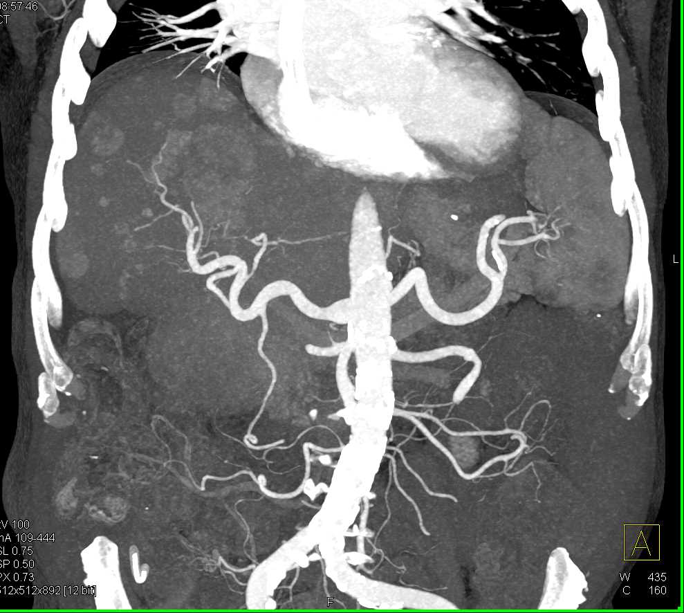 ctisus's tweet photo. October is Liver Cancer Awareness Month so today we'll be sharing cases of liver cancer

Multifocal Hepatocellular Carcinoma (Hepatoma): https://t.co/2ee2uxL0Yh https://t.co/kccpjXKleV