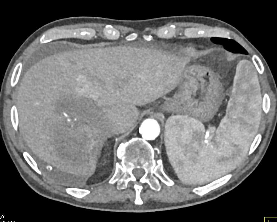 ctisus's tweet photo. October is Liver Cancer Awareness Month so today we'll be sharing cases of liver cancer

Multifocal Hepatocellular Carcinoma (Hepatoma): https://t.co/2ee2uxL0Yh https://t.co/kccpjXKleV