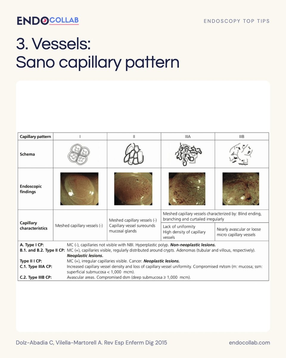 EndoCollabcom's tweet photo. Colon polyp characterization starts before the snare.
 
Four visual checks: Paris morphology, Kudo pit pattern, Sano vessels, NICE NBI pattern.
 
Which finding slows you down first: depression, irregular pits, or distorted vessels?
 
Save this for your next colonoscopy. https://t.co/cb0Jp8xlAC