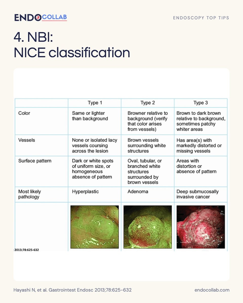 EndoCollabcom's tweet photo. Colon polyp characterization starts before the snare.
 
Four visual checks: Paris morphology, Kudo pit pattern, Sano vessels, NICE NBI pattern.
 
Which finding slows you down first: depression, irregular pits, or distorted vessels?
 
Save this for your next colonoscopy. https://t.co/cb0Jp8xlAC