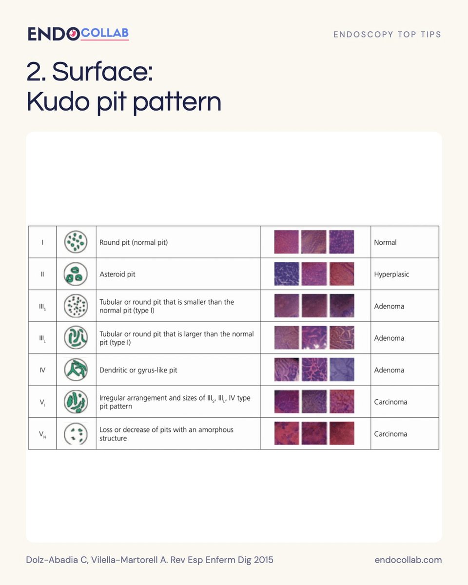 EndoCollabcom's tweet photo. Colon polyp characterization starts before the snare.
 
Four visual checks: Paris morphology, Kudo pit pattern, Sano vessels, NICE NBI pattern.
 
Which finding slows you down first: depression, irregular pits, or distorted vessels?
 
Save this for your next colonoscopy. https://t.co/cb0Jp8xlAC