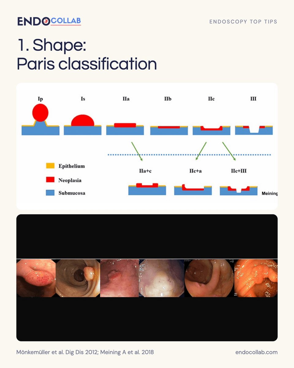 EndoCollabcom's tweet photo. Colon polyp characterization starts before the snare.
 
Four visual checks: Paris morphology, Kudo pit pattern, Sano vessels, NICE NBI pattern.
 
Which finding slows you down first: depression, irregular pits, or distorted vessels?
 
Save this for your next colonoscopy. https://t.co/cb0Jp8xlAC