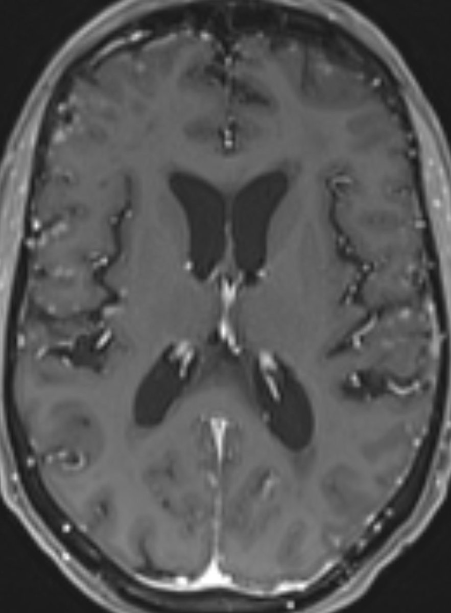 daniel_gewolb's tweet photo. ⭐️What is the most likely diagnosis in this 65 y/o female presenting with progressive cognitive decline over 3-4 weeks which acutely worsened over the past few days?
🔷PMH: Non-small cell lung cancer on targeted therapy
#Medicine #Neurology #Neurosurgery #radres #futureradres #MRI #FOAMed @Radiopaedia @TheASNR