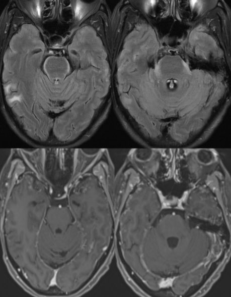 daniel_gewolb's tweet photo. ⭐️What is the most likely diagnosis in this 65 y/o female presenting with progressive cognitive decline over 3-4 weeks which acutely worsened over the past few days?
🔷PMH: Non-small cell lung cancer on targeted therapy
#Medicine #Neurology #Neurosurgery #radres #futureradres #MRI #FOAMed @Radiopaedia @TheASNR