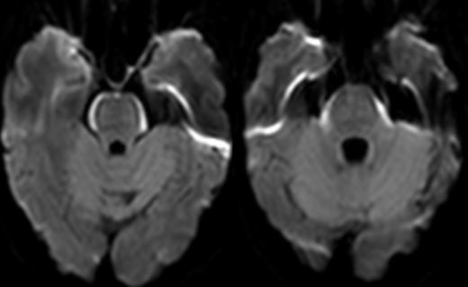daniel_gewolb's tweet photo. ⭐️What is the most likely diagnosis in this 65 y/o female presenting with progressive cognitive decline over 3-4 weeks which acutely worsened over the past few days?
🔷PMH: Non-small cell lung cancer on targeted therapy
#Medicine #Neurology #Neurosurgery #radres #futureradres #MRI #FOAMed @Radiopaedia @TheASNR