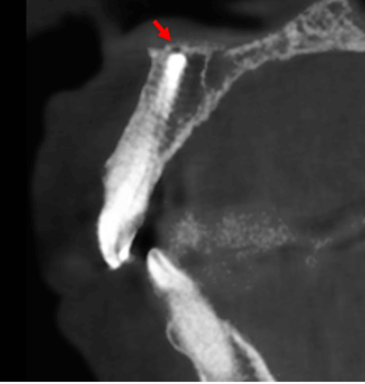 dentometric's tweet photo. Implante dental anterior comprometiendo el Canalis Sinuosus

Enlace: https://t.co/TYPDx2pnxj https://t.co/5NlzHEe9C7