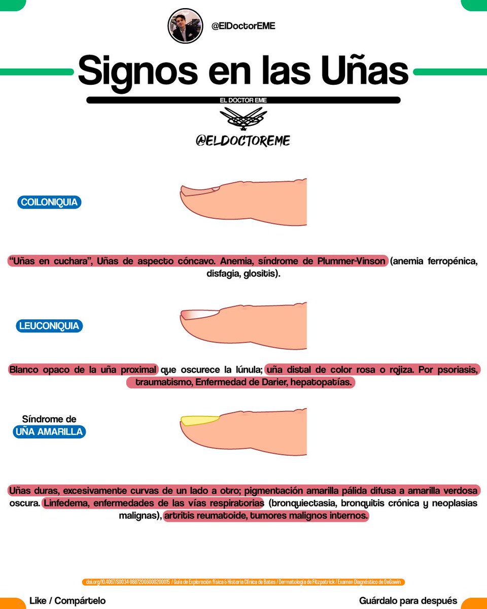 eldoctoreme's tweet photo. 🤓GUÍA RÁPIDA: SIGNOS EN LAS UÑAS🤓
📌Hilo con📌

•Nombre del Signo
•Descripción
•Etiologías
•Ejemplo

Encuentra más información en https://t.co/NPENohmrHa

#ENARM #MIR #USMLE #ENARM2026 https://t.co/aEOPPBJ0SD