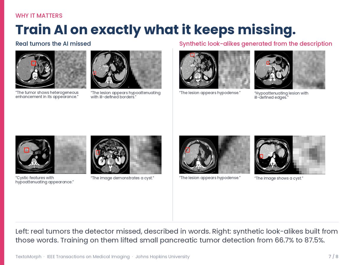 JHUCompSci's tweet photo. It also boosted the detection rate of large liver tumors to 87.7%, significantly outperforming previous methods, while generating synthetic tumors so realistic that radiologists frequently mistook them for real ones. (8/9) https://t.co/NwA0oT09yX