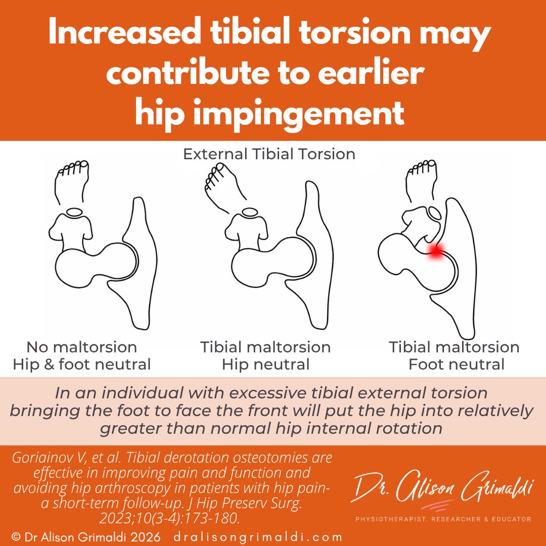 alisongrimaldi's tweet photo. #FactFriday Increased tibial external torsion may contribute to earlier hip impingement. Toes forward places the hip in relative IR, predisposing to impingement—worse with femoral retroversion. Lower limb malrotation can significantly affect hip load and pain. https://t.co/Xzk7VWLTNu