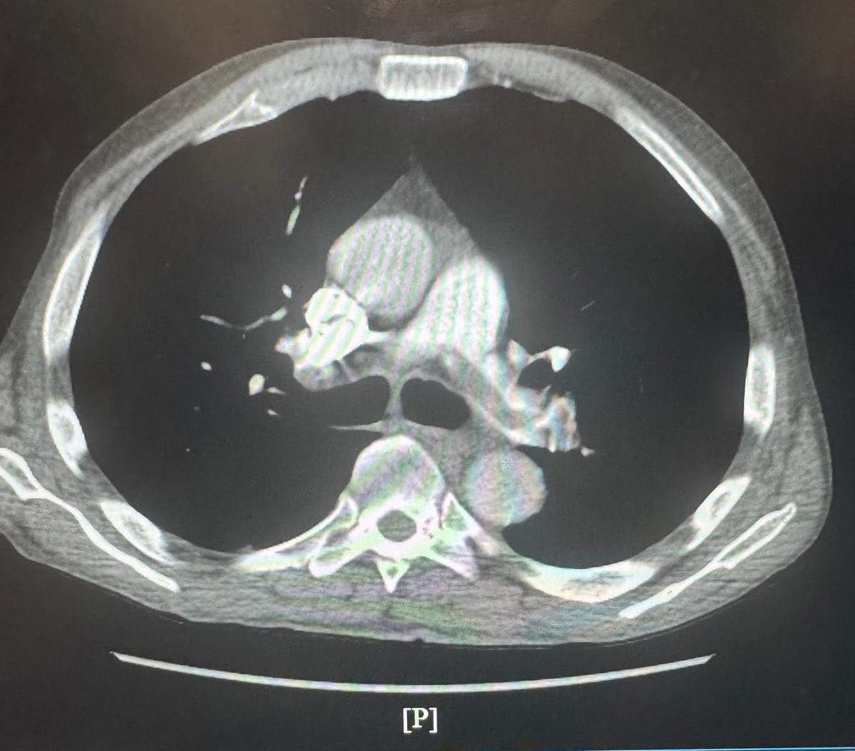 OBHCardiology's tweet photo. Patient with right leg DVT presented with acute saddle pulmonary embolism with acute cor pulmonale and significant right heart strain (RV/LV ratio 1.8), AHA/ACC Class D2. treated with bilateral mechanical Thrombectomy. @ChadowHal https://t.co/DXC4M3393j