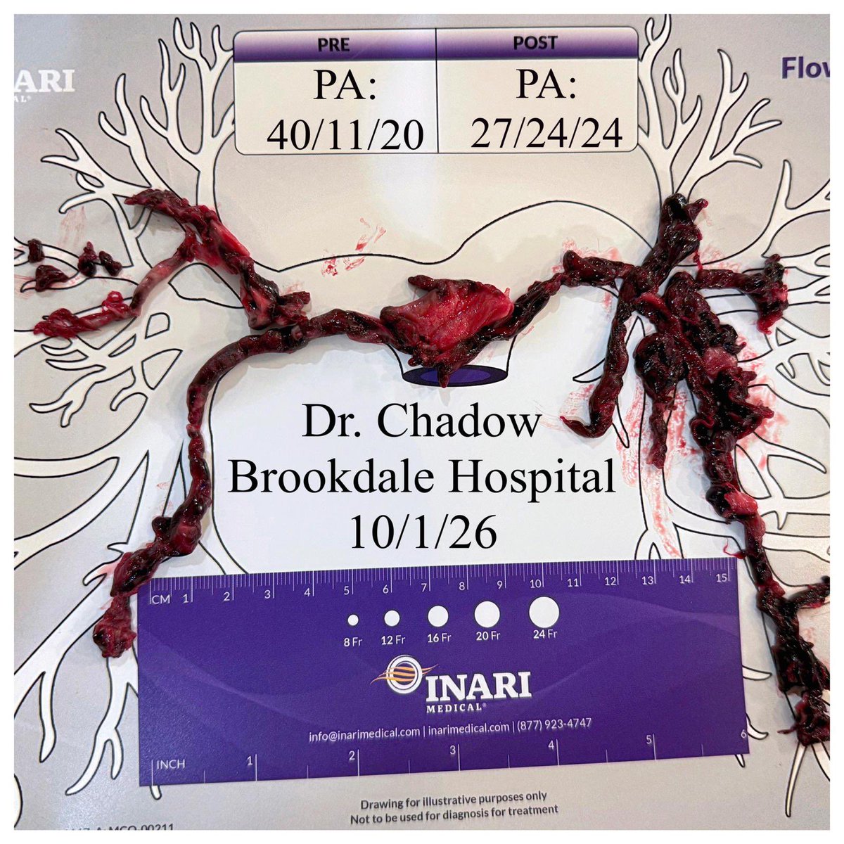 OBHCardiology's tweet photo. Patient with right leg DVT presented with acute saddle pulmonary embolism with acute cor pulmonale and significant right heart strain (RV/LV ratio 1.8), AHA/ACC Class D2. treated with bilateral mechanical Thrombectomy. @ChadowHal https://t.co/DXC4M3393j