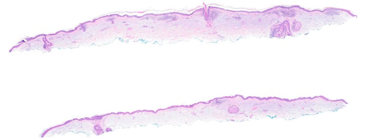 ASDPTweets's tweet photo. Make the Dx: ASDP October Case Study
75-year-old male with papules on chest, back, and arms
Learn more at https://t.co/hkidLEbzga 
#asdpcasestudy; #dermatopathology; #dermpath https://t.co/xMpNb0t90K