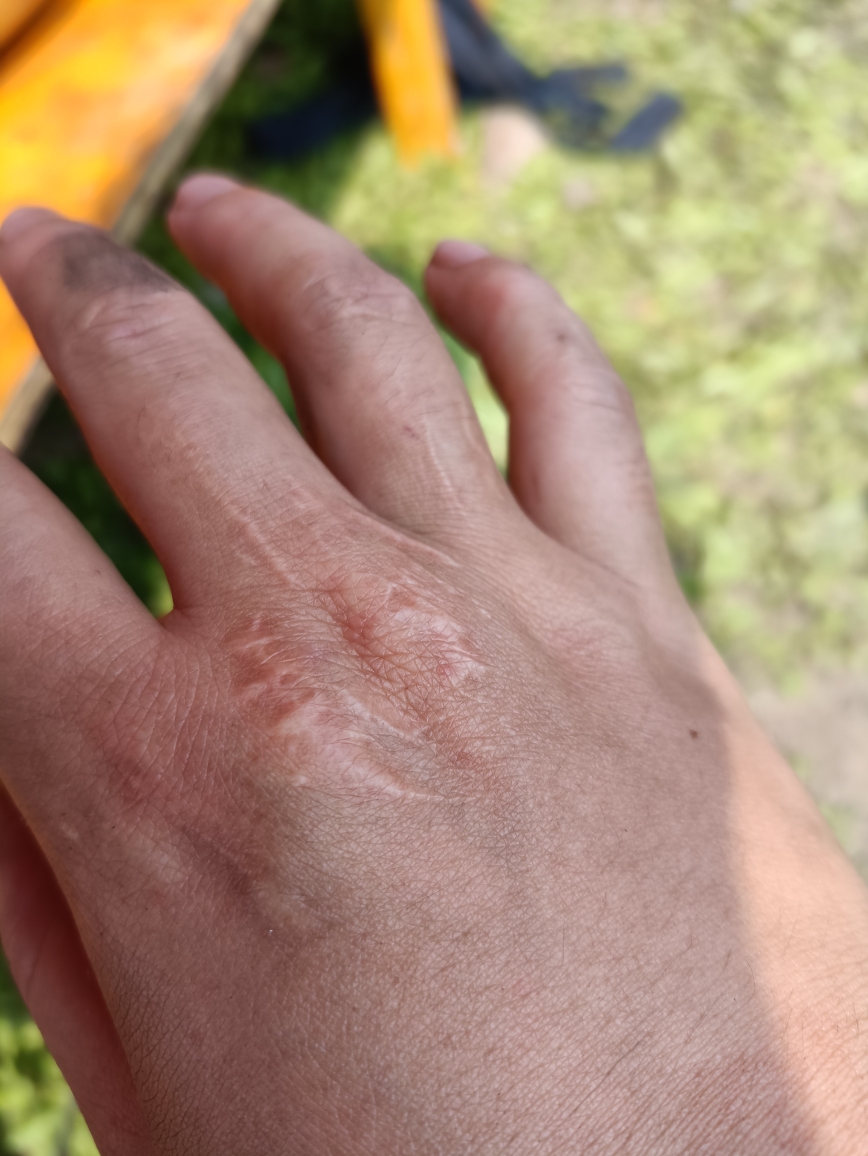 MackenzieCvm's tweet photo. Cada marca en mi mano es una historia que me hizo más fuerte. No tengo miedo de las cicatrices, porque son prueba de que seguí adelante.， https://t.co/2MBXuEHK4d