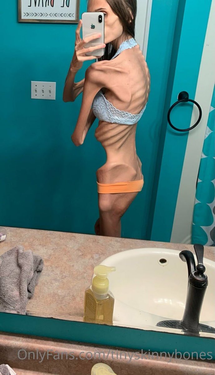 SkinnyAdmirer's tweet photo. #thinspo #thinspO0 #bonespo #bonesp0 #edtwt #anablur #edtw #twana #twed #edblur #edtblur #anatw #edrtwt #shedtwt https://t.co/bsufUQz5PB