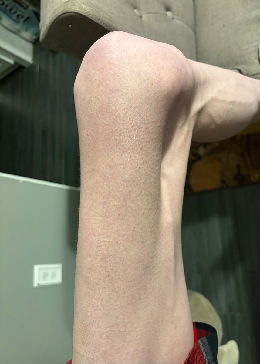 Lylylimia's tweet photo. weird concave part of my leg https://t.co/146OumUdzd